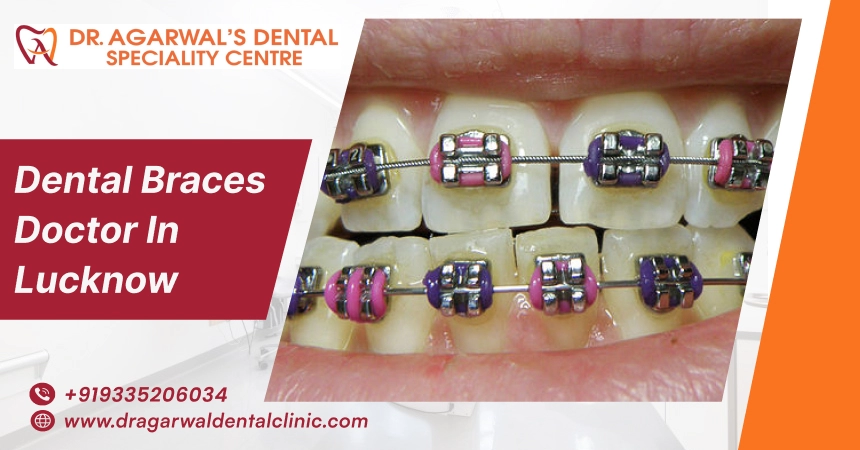 dental braces doctor in lucknow