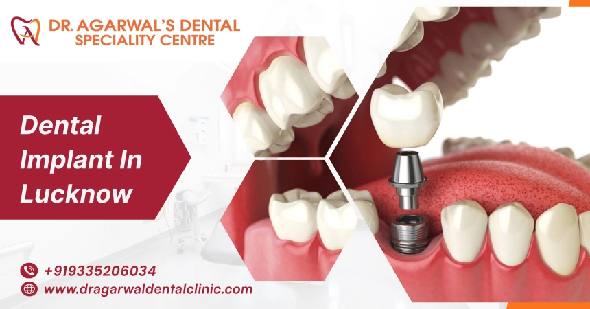 dental implant in lucknow