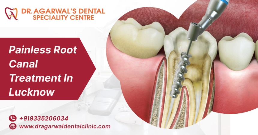 painless root canal trreatment in lucknow